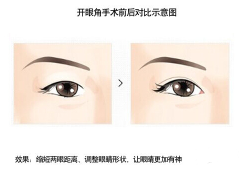 开内眼角和开外眼角有什么区别