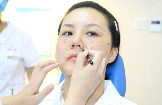 现场面部注射乔雅登填充鼻唇沟