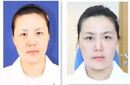 王丹茹教授演示乔雅登MD Codes?注射法