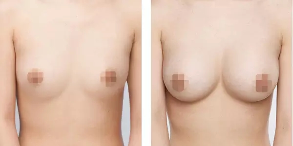 特贝茨双平面隆胸图片对比