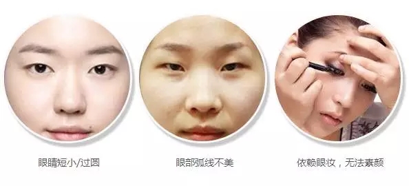 美莱开眼角优势