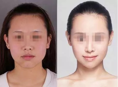 水光嫩肤前后对比