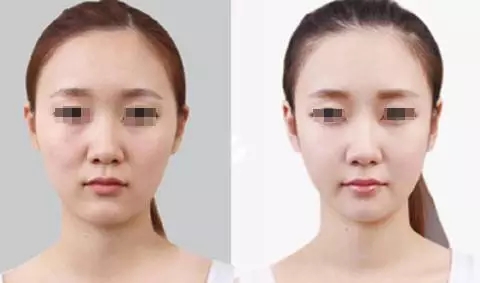 水光嫩肤前后对比对比图