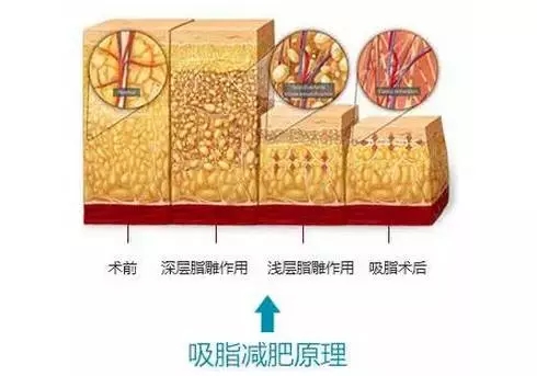 美莱多维立体吸脂原理