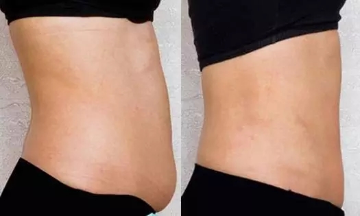 腰腹部吸脂前后对比