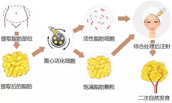 自体脂肪移植原理
