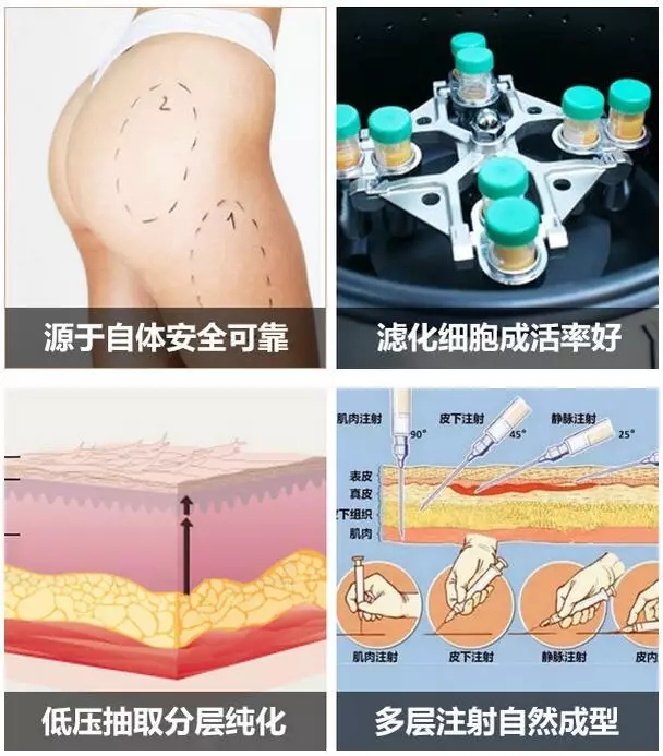 美莱自体脂肪优势
