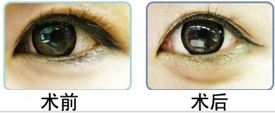 上海玻尿酸注射卧蚕有风险吗