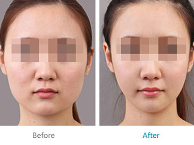 上海改脸型手术的价格是多少