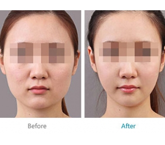 上海改脸型手术的价格是多少