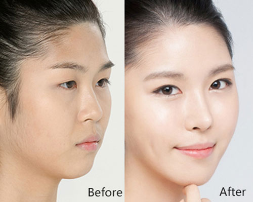 注射隆鼻or假体隆鼻