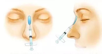注射隆鼻or假体隆鼻