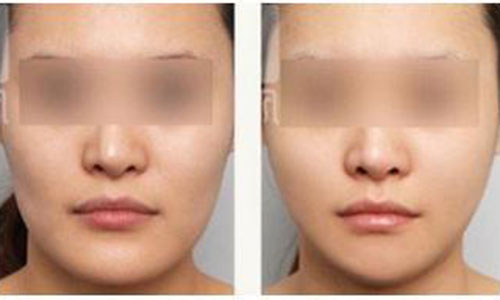 改脸型后注意3大禁忌食物