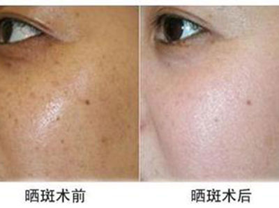 激光去雀斑面子不再难看