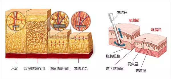 美莱多维立体吸脂