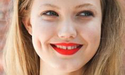 酒窝成形术会出现后遗症吗