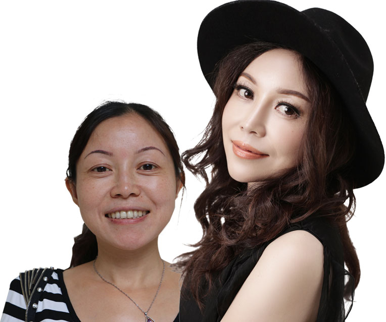 美莱除皱前后对比