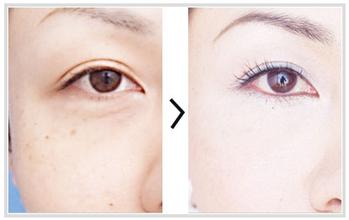 光子嫩肤能维持多久