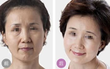 上海水光针注射除皱去哪家好