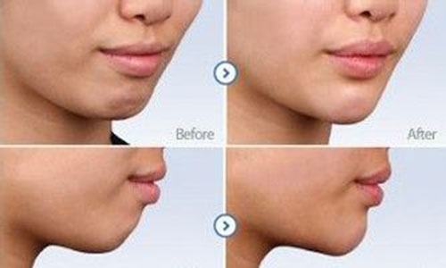 上海玻尿酸注射隆下巴价格贵吗