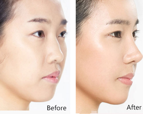 上海假体隆鼻手术多少钱