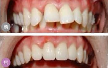 上海牙齿矫正会痛吗?