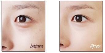 有黑眼圈怎么办,怎么去除