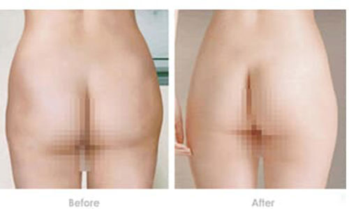 上海臀部吸脂有副作用吗