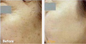 彩光嫩肤能祛除蝴蝶斑吗