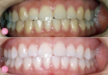 上海牙齿冷光美白多少钱快速