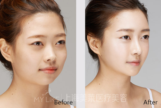 进口多少钱一针