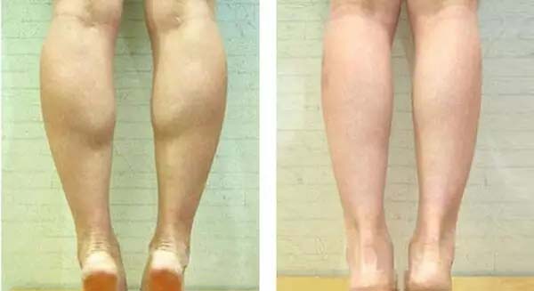瘦腿针对比