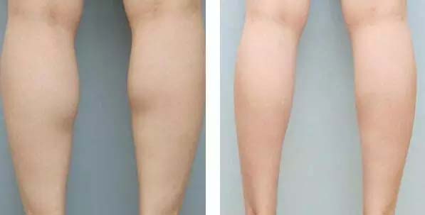 打瘦腿针对比图