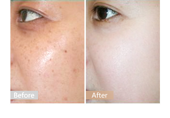 怎样才能快速去除蝴蝶斑