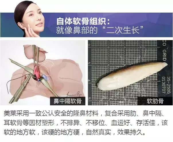 自体软骨隆鼻