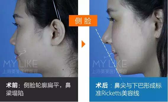 隆鼻前后对比