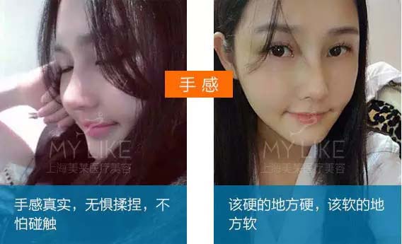 隆鼻前后对比对比图