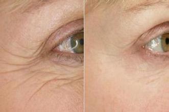 如何去除眼角鱼尾纹
