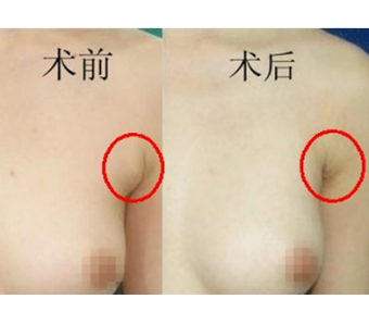 进行副乳切除术前要注意哪些方面