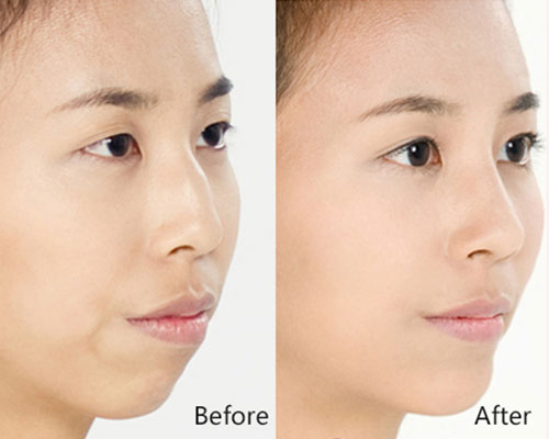 假体隆鼻的并发症有哪些