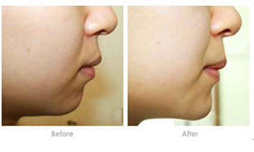 玻尿酸隆下巴的优势有哪些