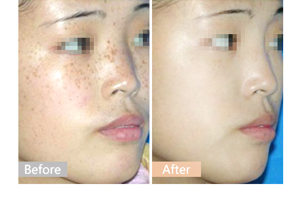 去晒斑什么方法好