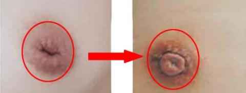 如何解决乳头内陷的问题