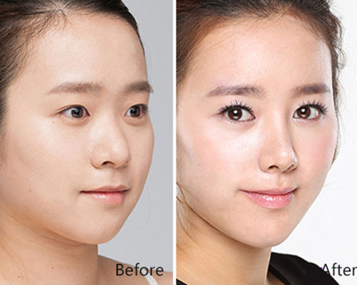 假体隆鼻会影响呼吸吗