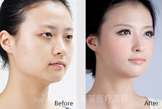 面部吸脂瘦脸后有副作用吗