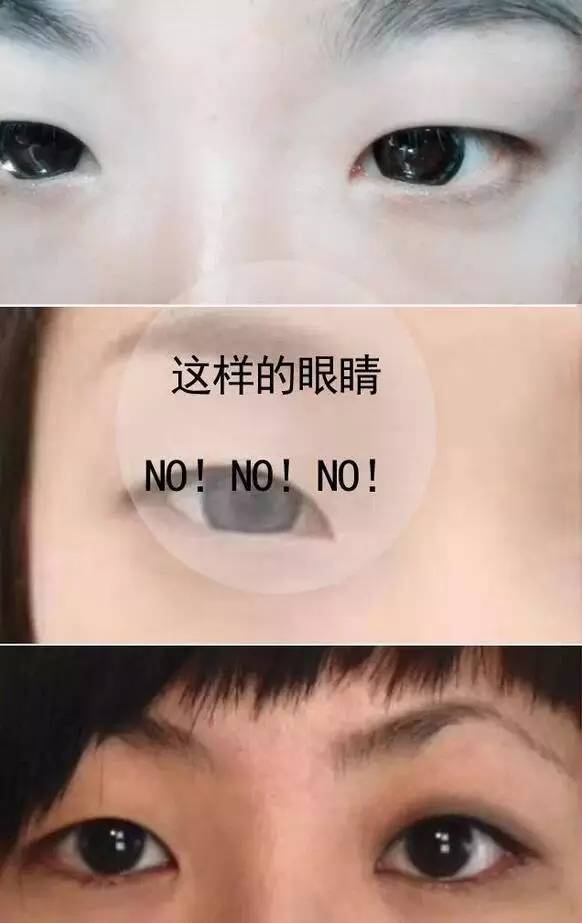 单眼皮