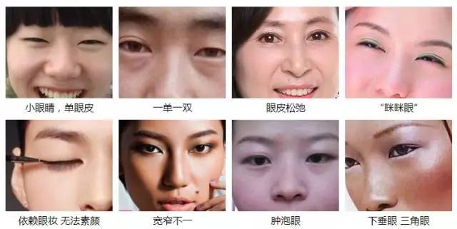 割双眼皮适应症