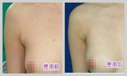 副乳切除后还会不会反复