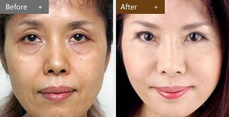 上海电波拉皮可以祛除眼袋吗