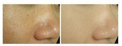 水光注射可以收缩毛孔吗